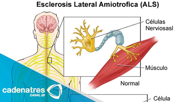 En Castilla La Mancha se diagnostican  3 casos de ELA al mes y la enfermedad afecta a 127 personas 